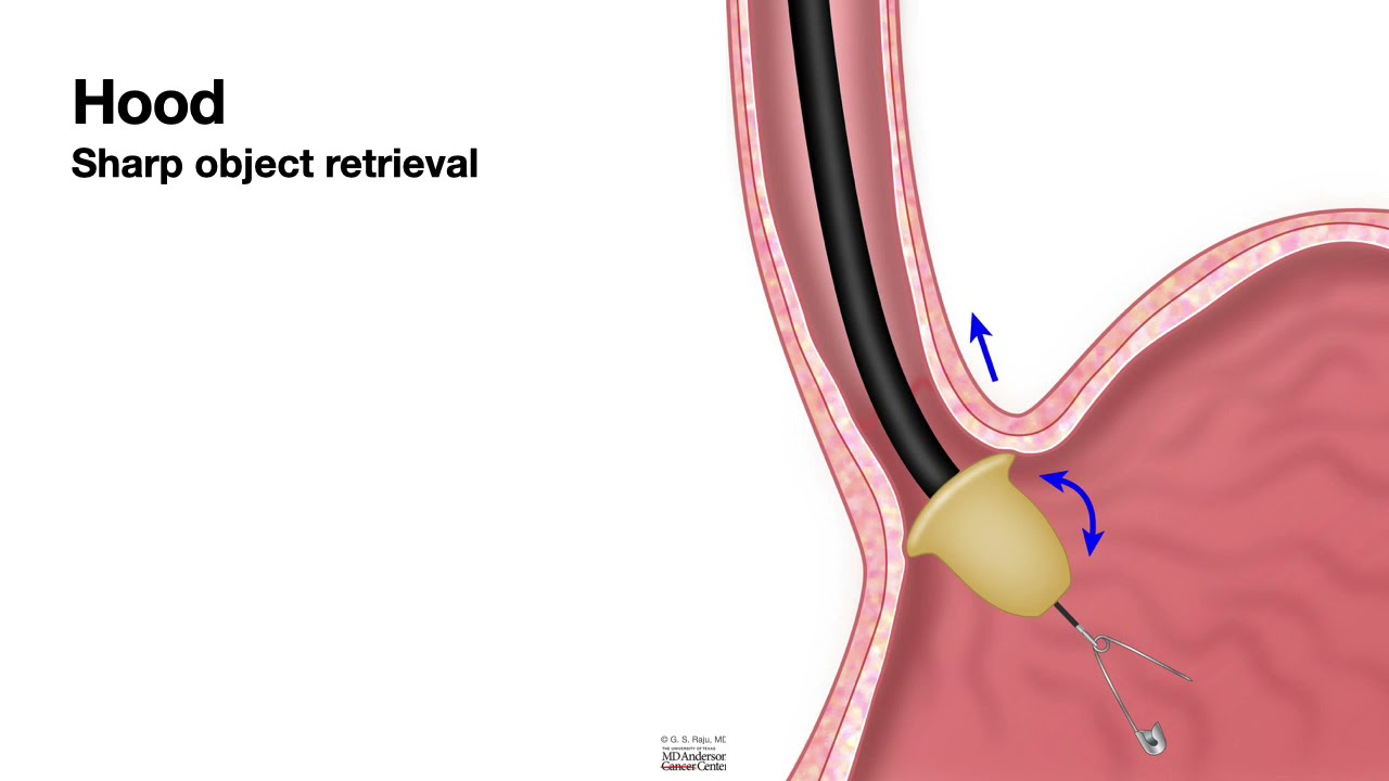 HCC 1472-Lesson 12e-Foreign Body Retrieval-Hood