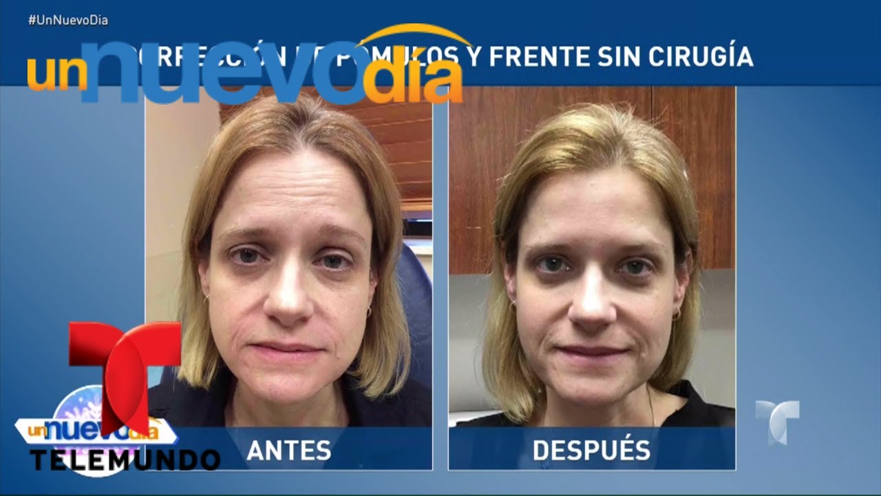 &iexcl;Mejora la apariencia de tu cara sin cirug&iacute;as! | Un Nuevo D&iacute;a | Telemundo