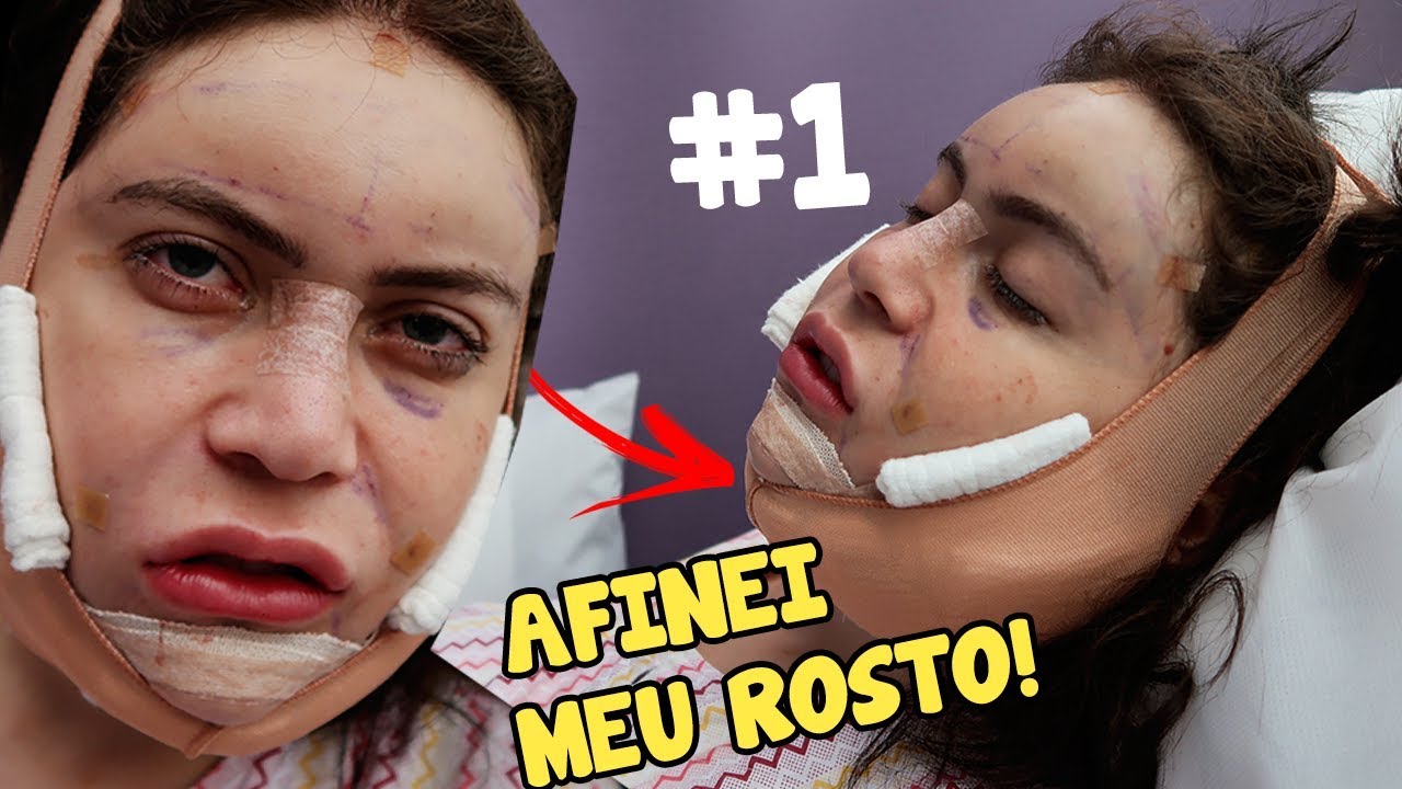 MINHA CIRURGIA PLÁSTICA NA COREIA DO SUL #1 - VIREI COREANA!  (V LINE surgery)