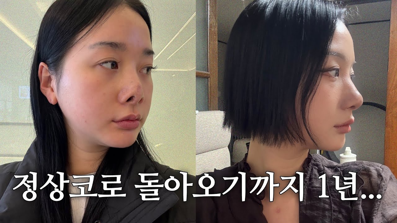 구축코, 함몰, 들린코로 코재수술만 3번째😥 1년간 힘들었어요 구축코 재건수술 후기 [화린3Vlog]