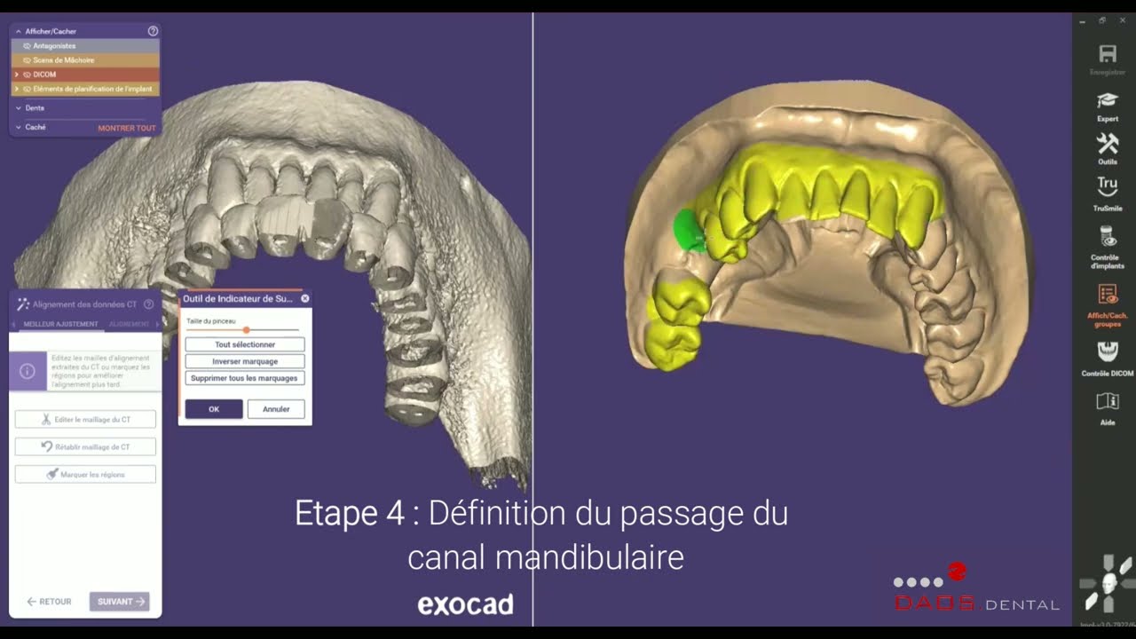 Planification implantaire avec Exoplan 3.0 Exocad par Daos Dental