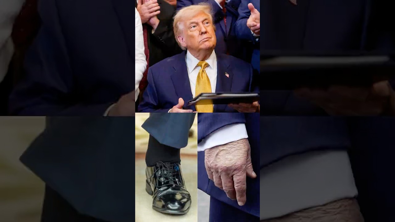 Trump Diagnosed With Chronic Venous Insufficiency