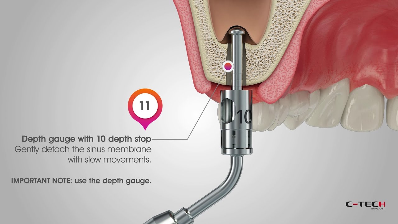 Crestal Sinus Lift - ENG