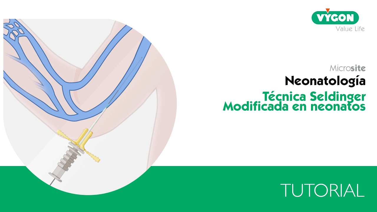 Recomendaciones para realizar la t&eacute;cnica Seldinger Modificada en neonatos