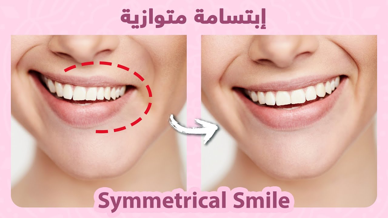 How to naturally fix smile asymmetry