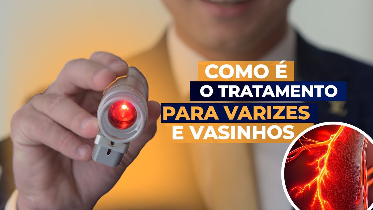 Como Funcionam os Tratamentos Para Varizes e Vasinhos