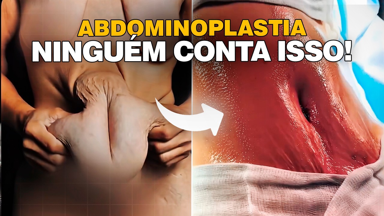 10 Fatos Importantes Que Você Precisa Saber Sobre Abdominoplastia