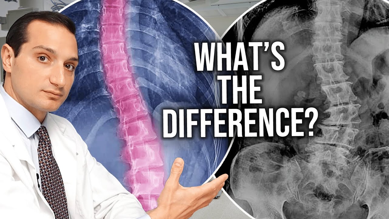 These 2 Scoliosis Patients Needed Completely Different Surgeries