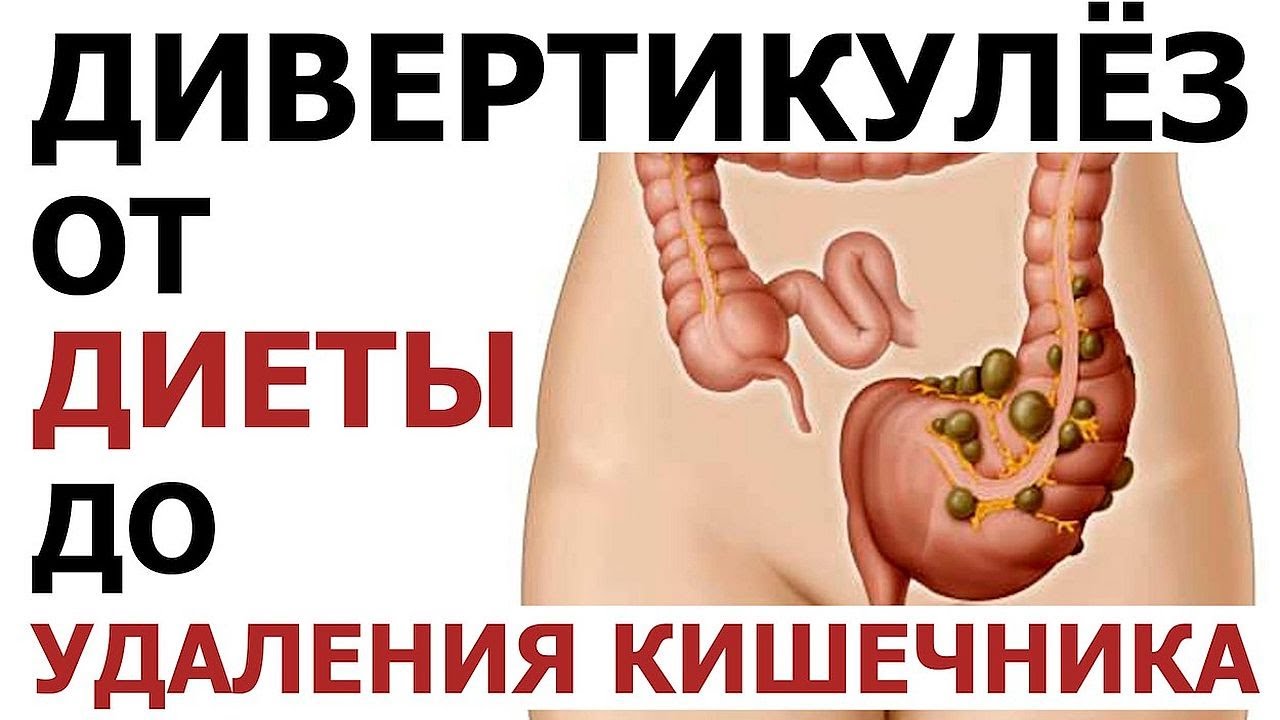 Что такое дивертикулы кишечника. Дивертикулез и дивертикулит. Судьба пациента с дивертикулёзом.
