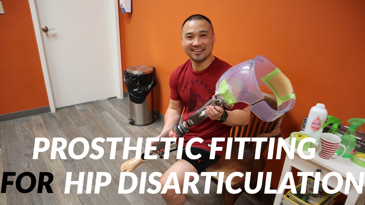Prosthetic Fitting For Hip Disarticulation [Full Version]/고관절이단술 후 의족 맞추는 과정 [캐나다 의족 🇨🇦]