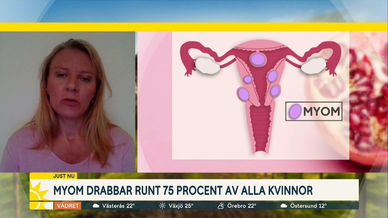 Myom drabbar 75 % av alla kvinnor – då bör du söka hjälp - Nyhetsmorgon (TV4)