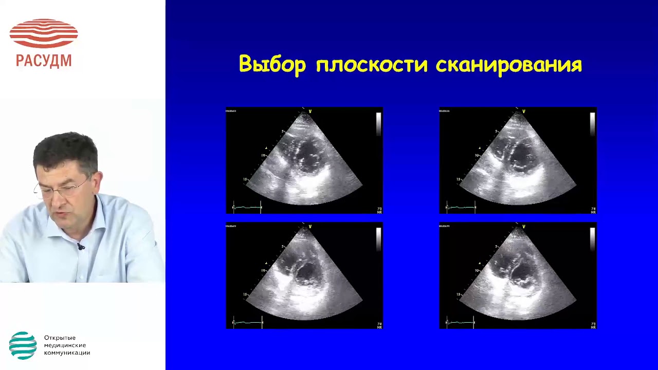 Эхокардиография в диагностике и ведении пороков митрального клапана сердца