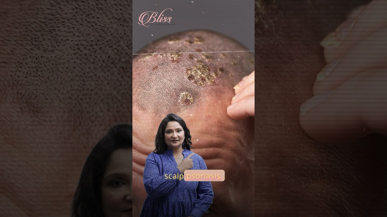 Scalp Psoriasis Treatment | Skin Doctor in Ludhiana | Dr. Shikha Aggarwal