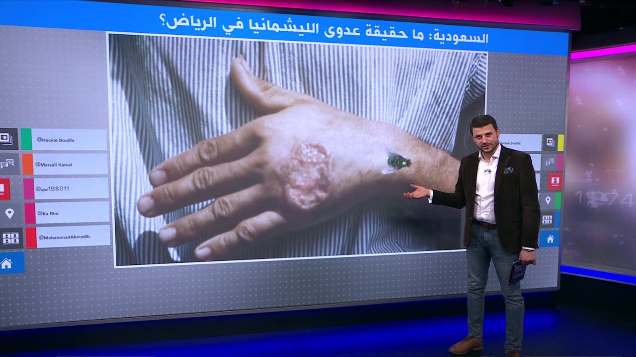 ما حقيقة انتشار عدوى الليشمانيا في السعودية؟