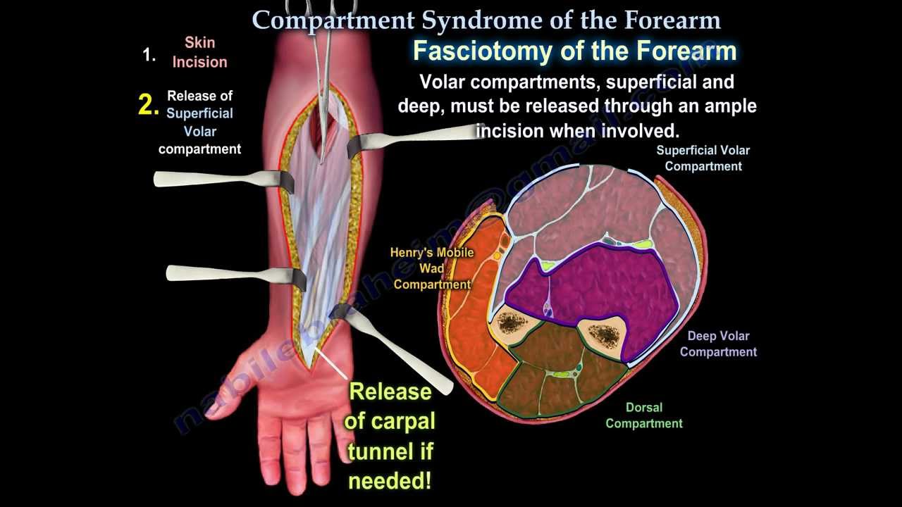 Compartment Syndrome Of The Forearm - Everything You Need To Know - Dr. Nabil Ebraheim