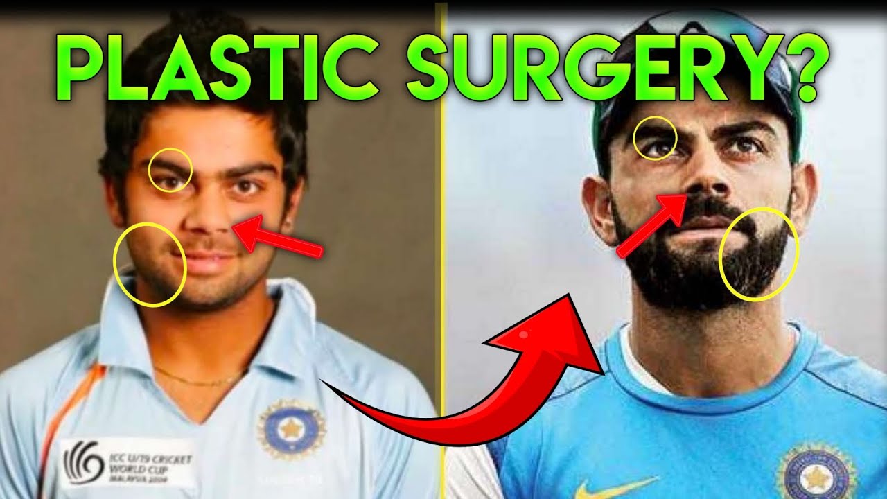 Virat Kohli's Plastic Surgery Decoding || Nose Surgery