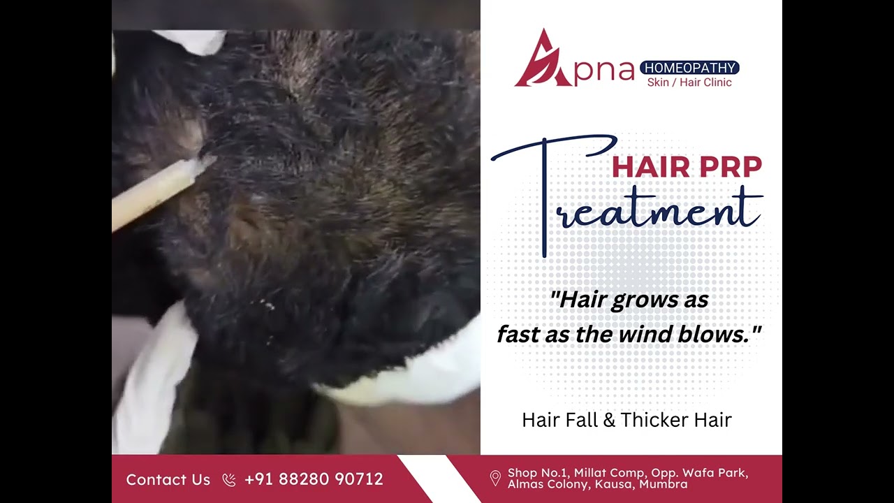 Hair PRP Treatment in Mumbra | DR ABIDA KHAN APNA HOMOEOPATHY SKIN / HAIR CLINIC