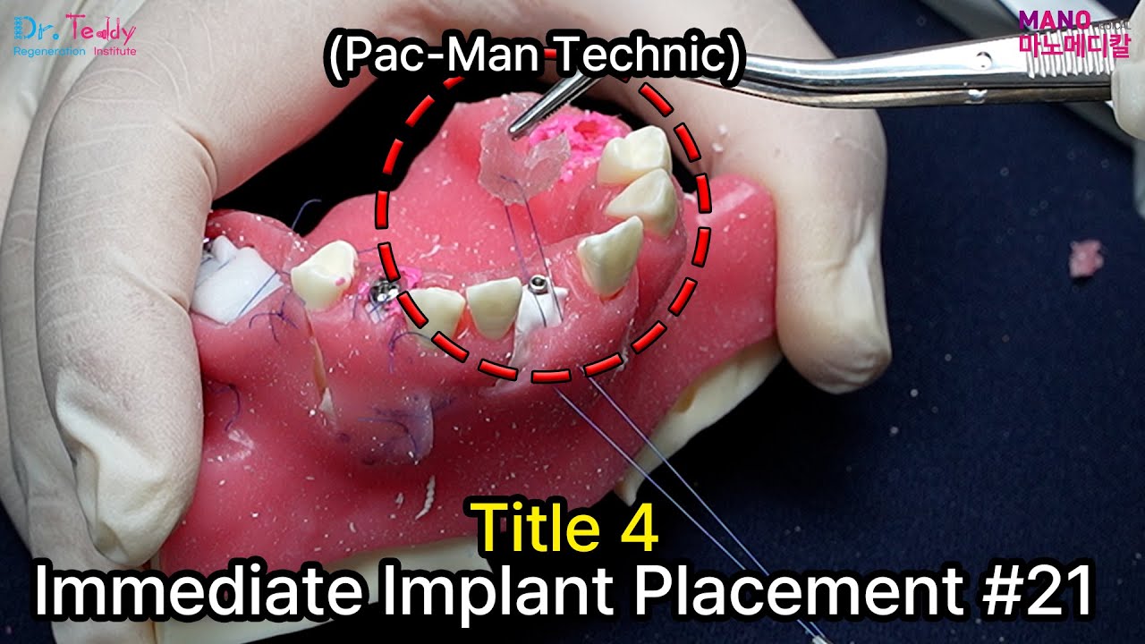Title 4 : Immediate Implant Placement #21 #dr_teddy_regeneration_institute #manomedical #dental