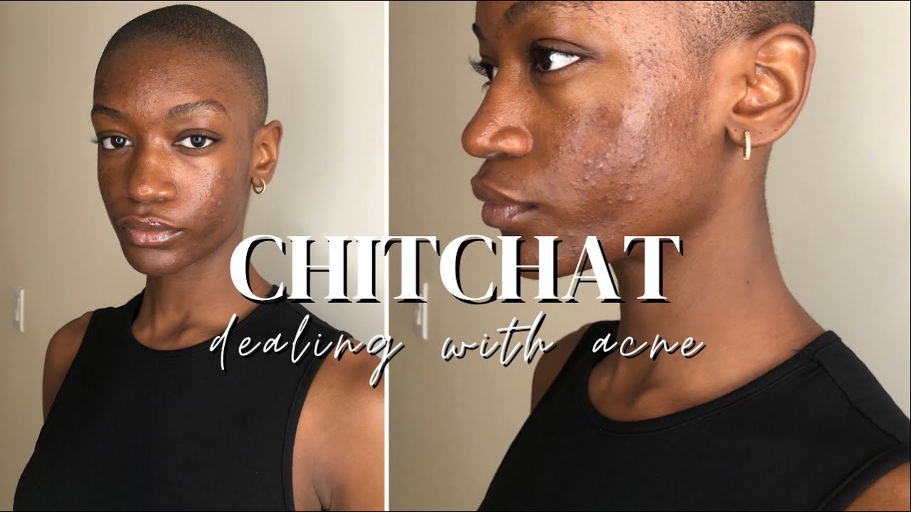 Struggling with Acne as a Model | Clindamycin and Tretinoin