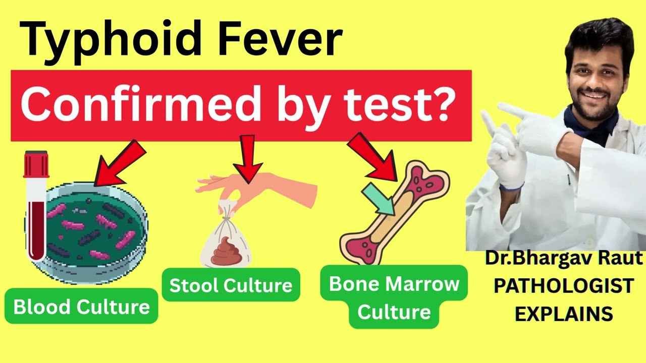 Typhoid Fever can be confirmed by which test? | Best Test for Typhoid Diagnosis | Most Accurate