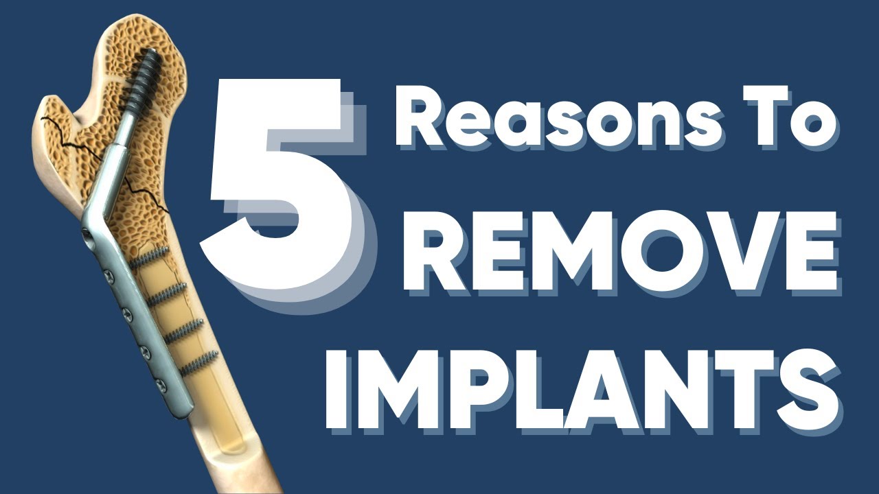 फ्रैक्चर ठीक होने के बाद क्या प्लेट/स्क्रू/रोड निकलना ज़रूरी है ?implant removal after fracture heals