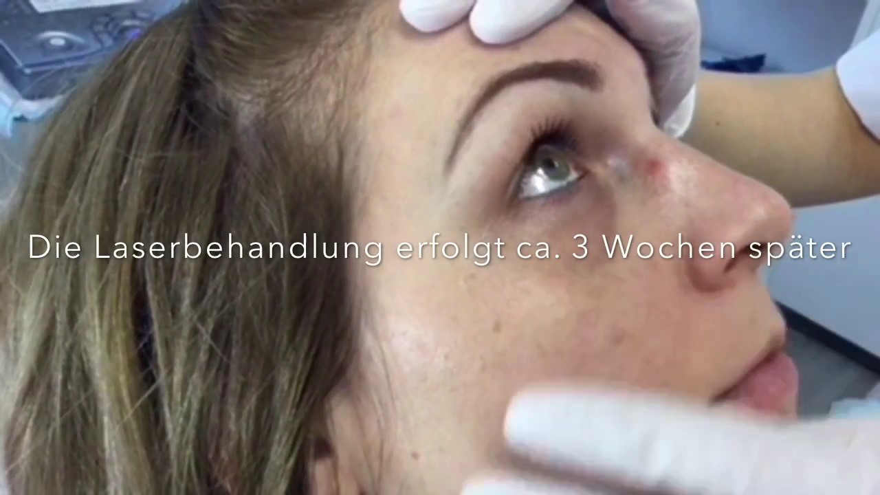 Ultraschall-kontrollierte Unterspritzung. Behandlung von Augenringen mit Hyaluron bei Dr. Ahlemann