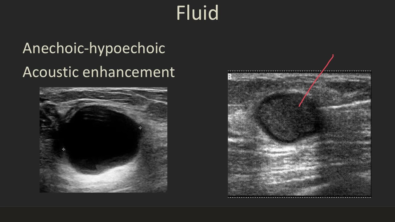 Ultrasound 101 Part 5 Terminology and Tissues.mp4