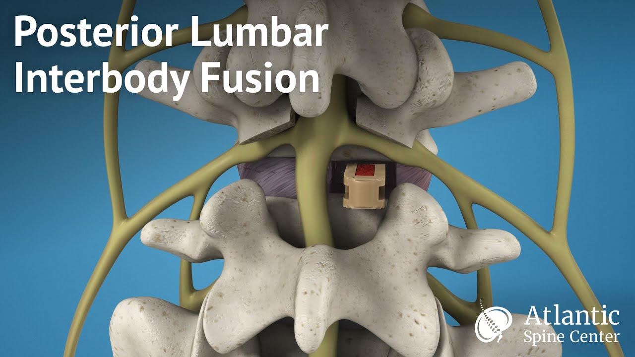 Posterior Lumbar Interbody Fusion (PLIF)