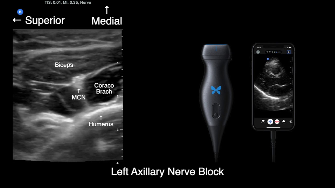 US anatomy for axillary nerve block with Butterfly-IQ