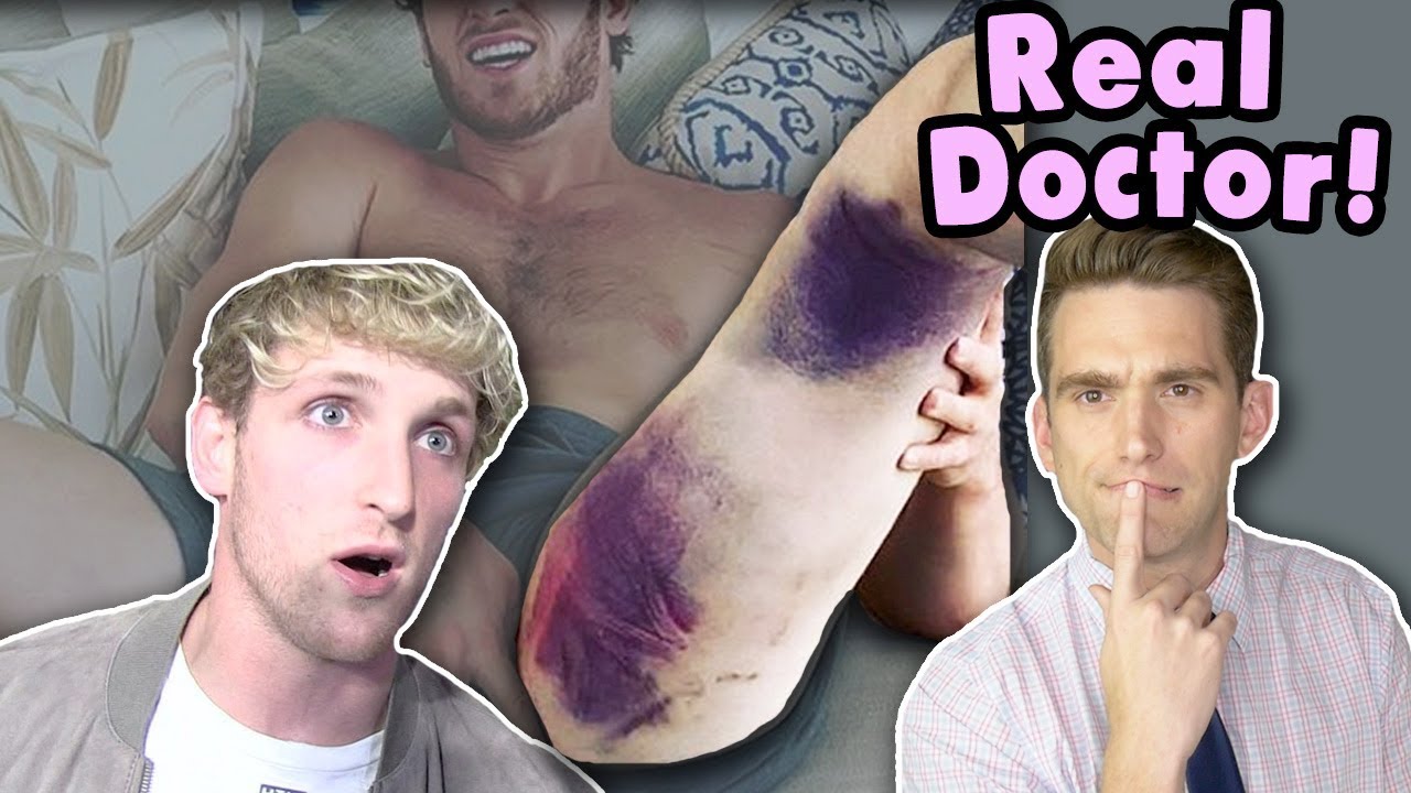 Doctor Explains Hamstring Bruise and Logan Paul Injury | REAL or FAKE?