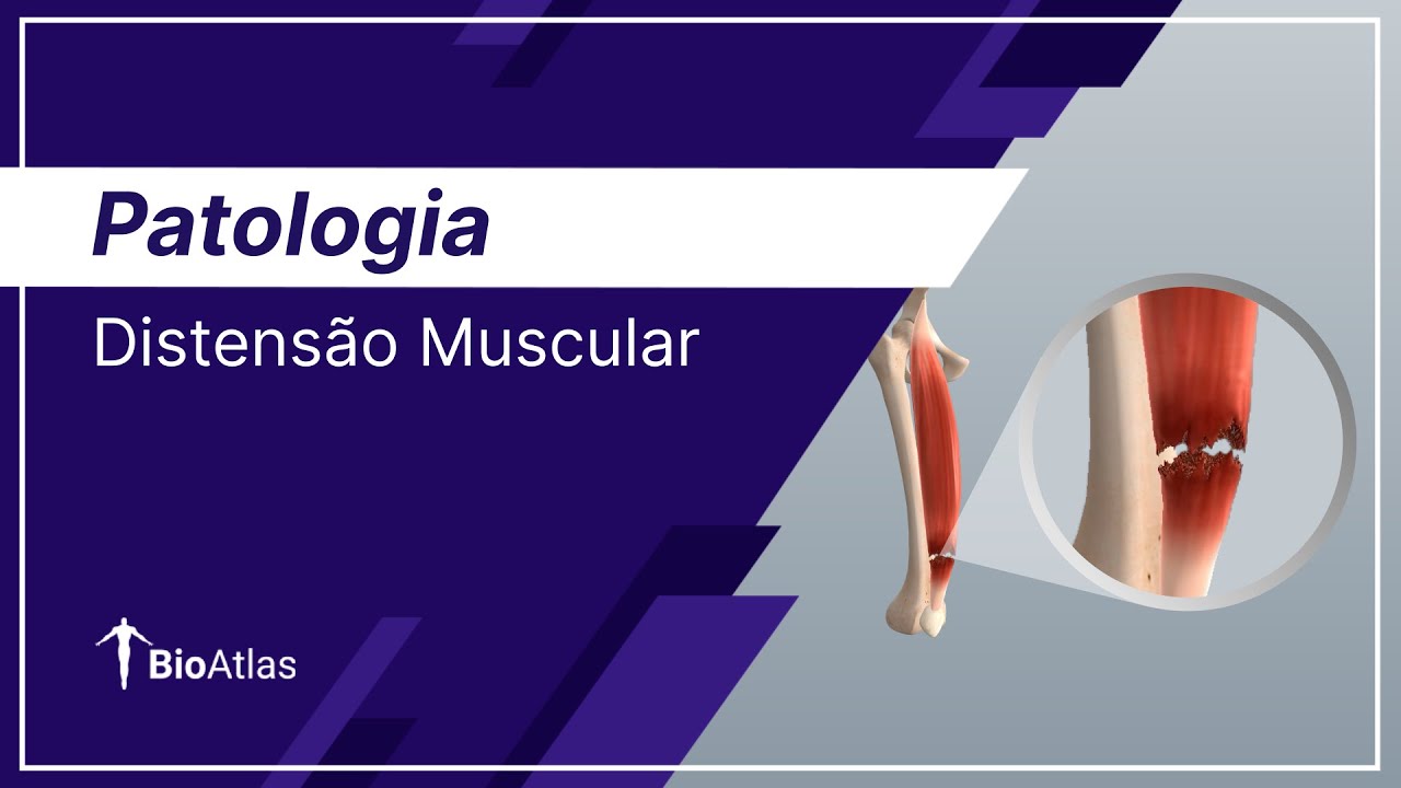 Distens&atilde;o Muscular | Patologia | BioAtlas