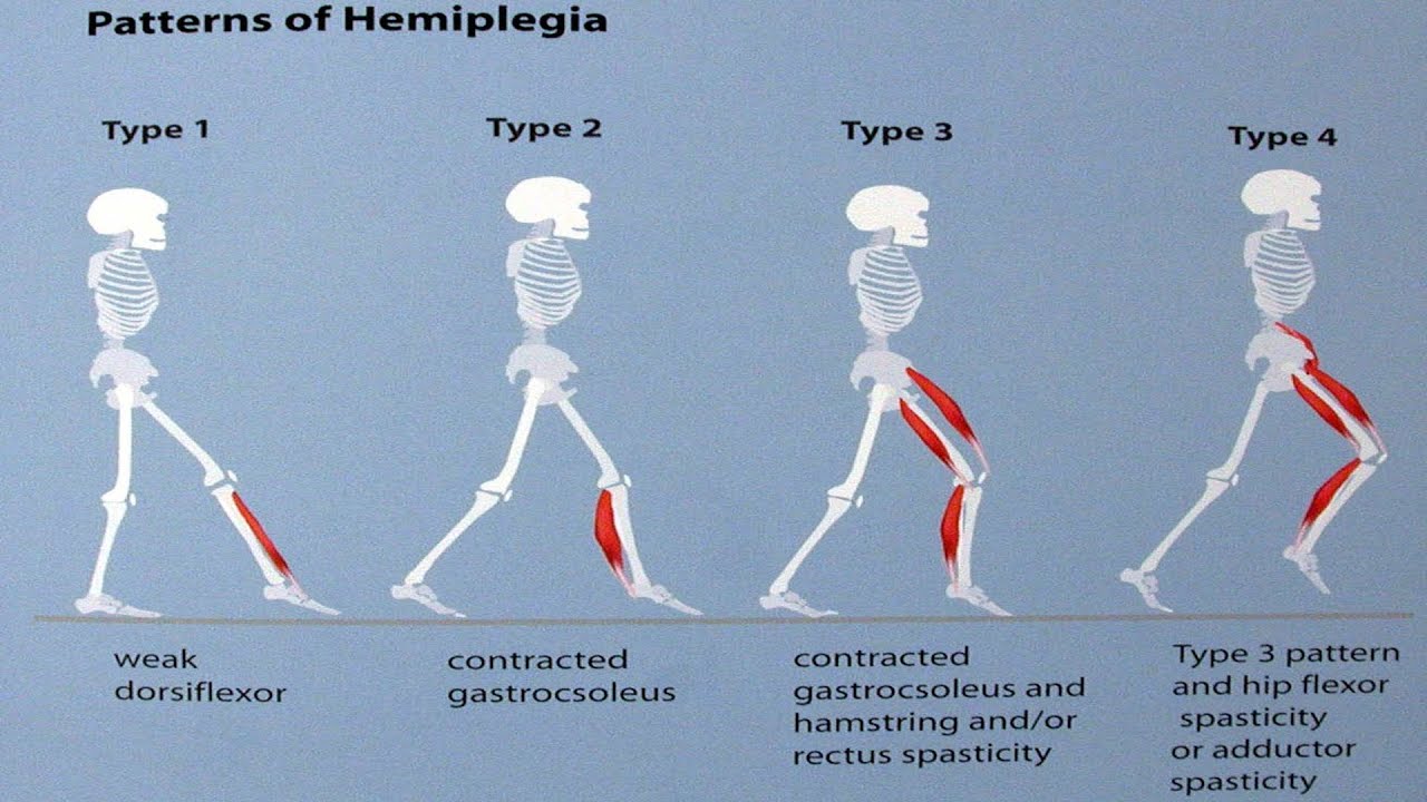 Gait patterns in Children with hemiplegic cerebral Palsy