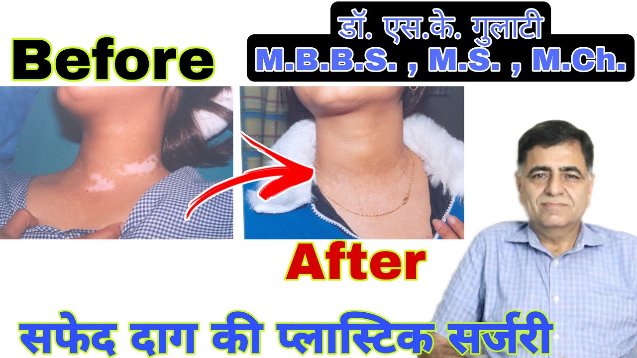 Surgery for white patches // Dr. S. K. Gulati