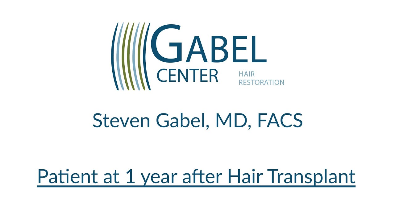 Gabel Patient   1 year Hair Transplant Results