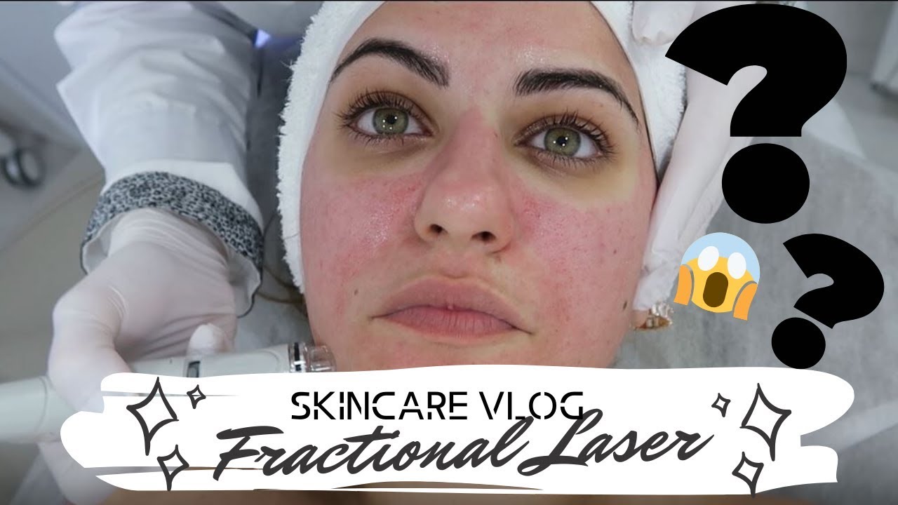 SKINCARE VLOG:Έκανα fractional λέιζερ!