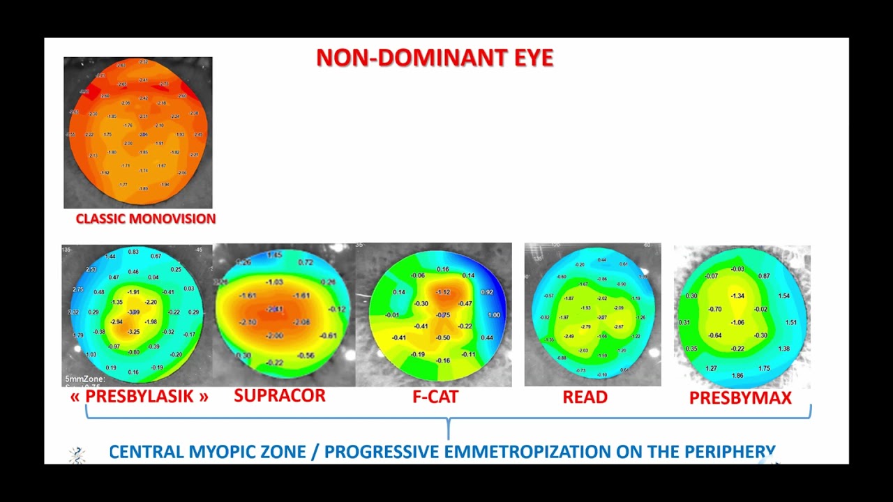 Oracles of Eye Innovation Webinar VII: Enhancing monovision with multifocality