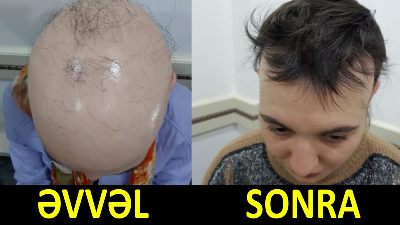 Saçımız buna görə tökülür - Müalicənin yolları