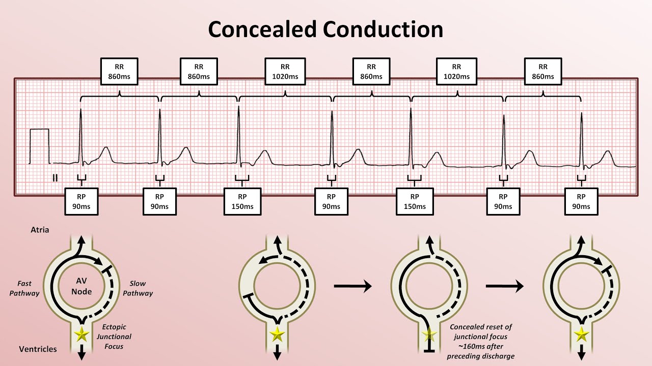 Advanced EKGs - Miscellaneous EP Topics