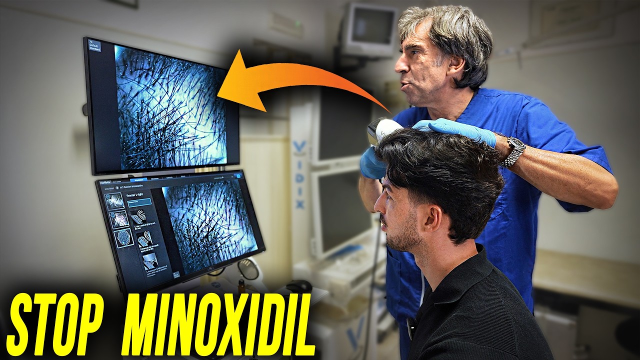 STOP MINOXIDIL con il Dr. Griselli | 3 anni dopo il trapianto