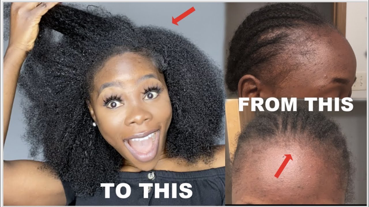HOW TO REGROW YOUR EDGES/HAIRLINE BACK FAST | 2 PRODUCTS YOU NEED + BEFORE AND AFTER PICs | part 2