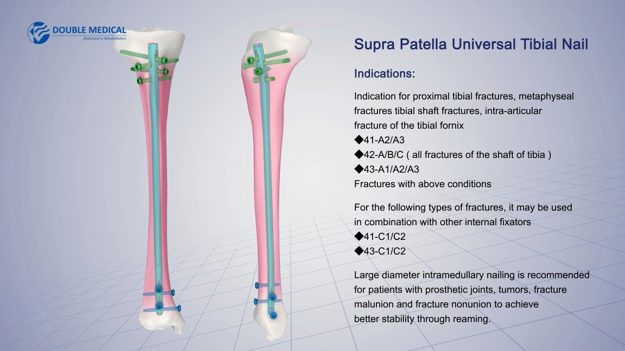 Double Medical Supra Patella Universal Tibial Nail（SPTN）