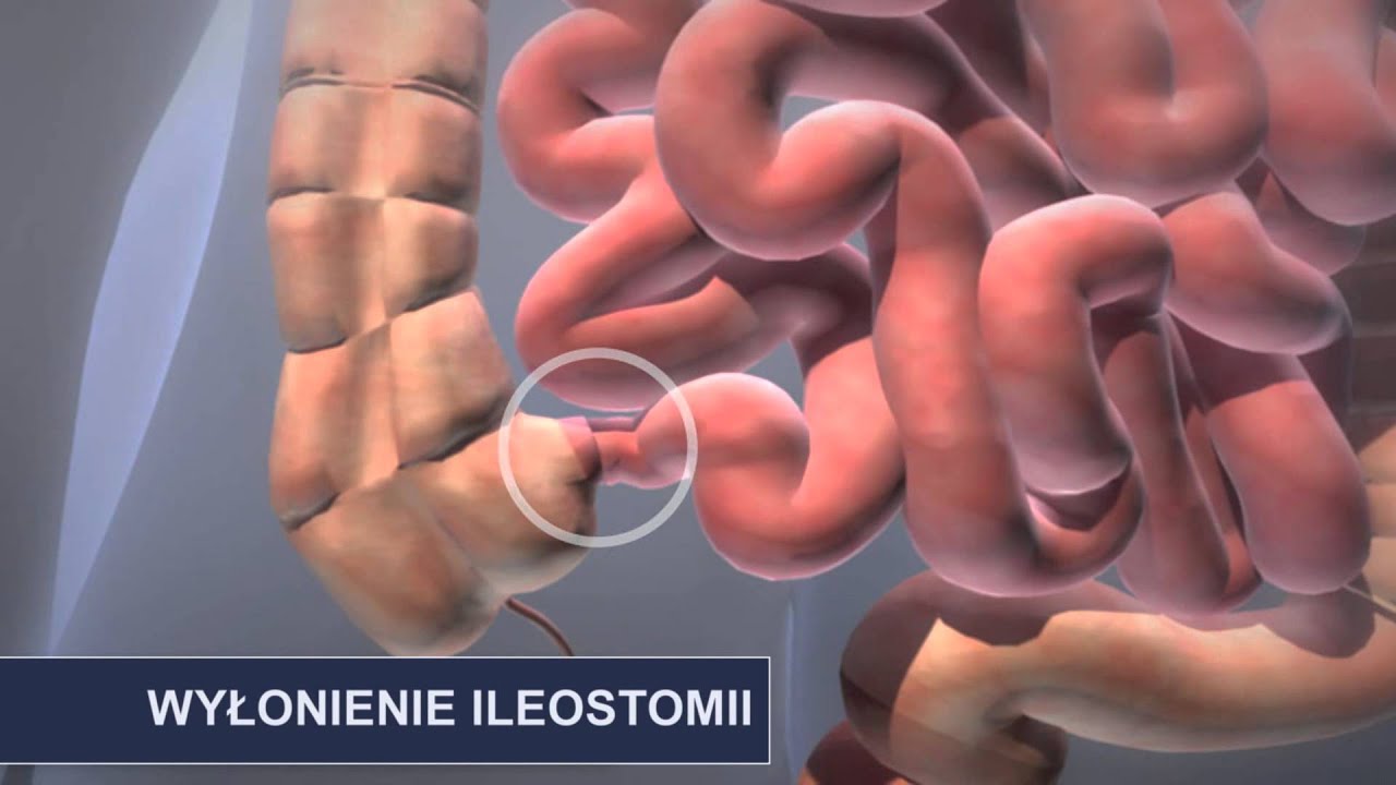 Jak powstaje ileostomia