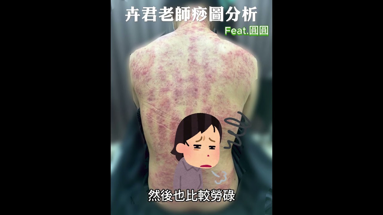 舊傷、痧色與血流循環：身體透露的隱藏訊息