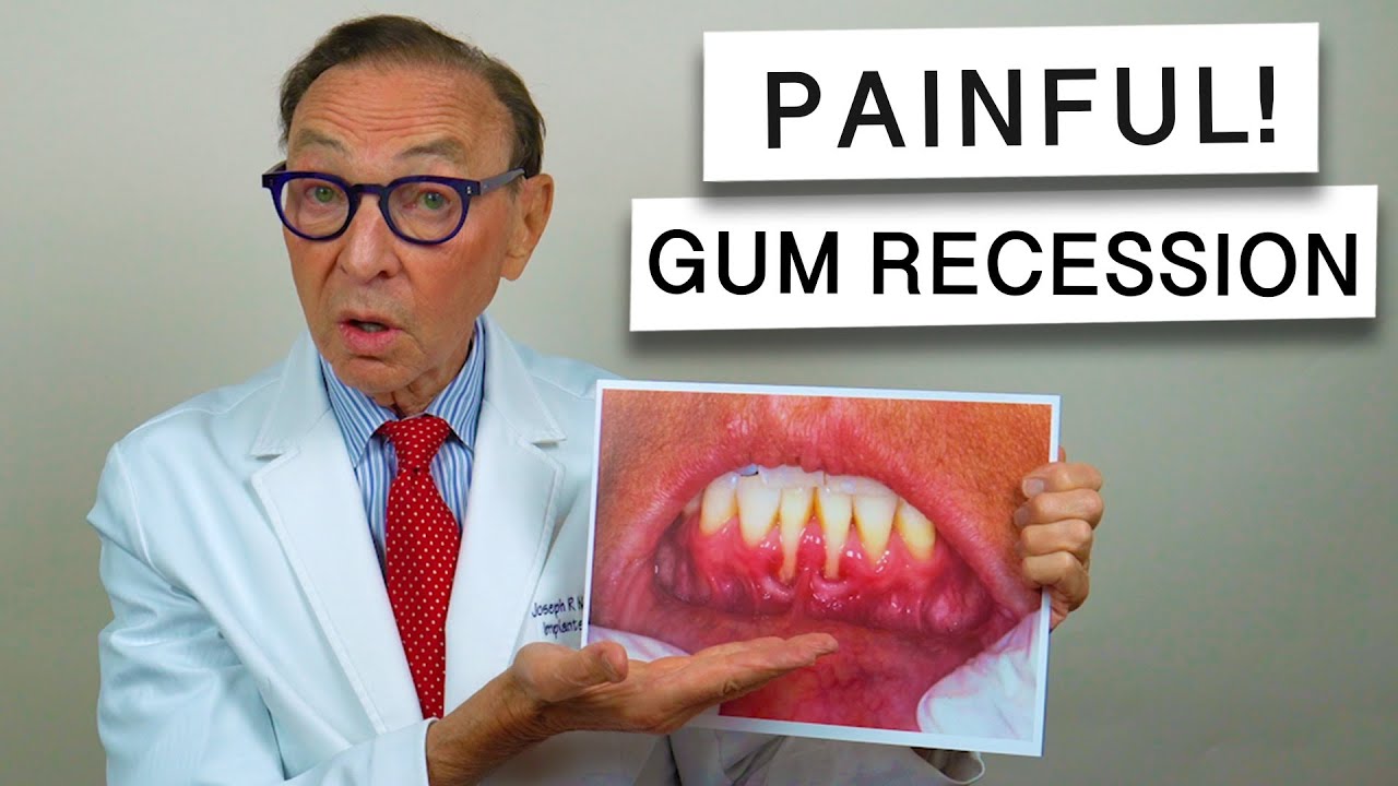 SEVERE Gum Recession from ORTHODONTICS