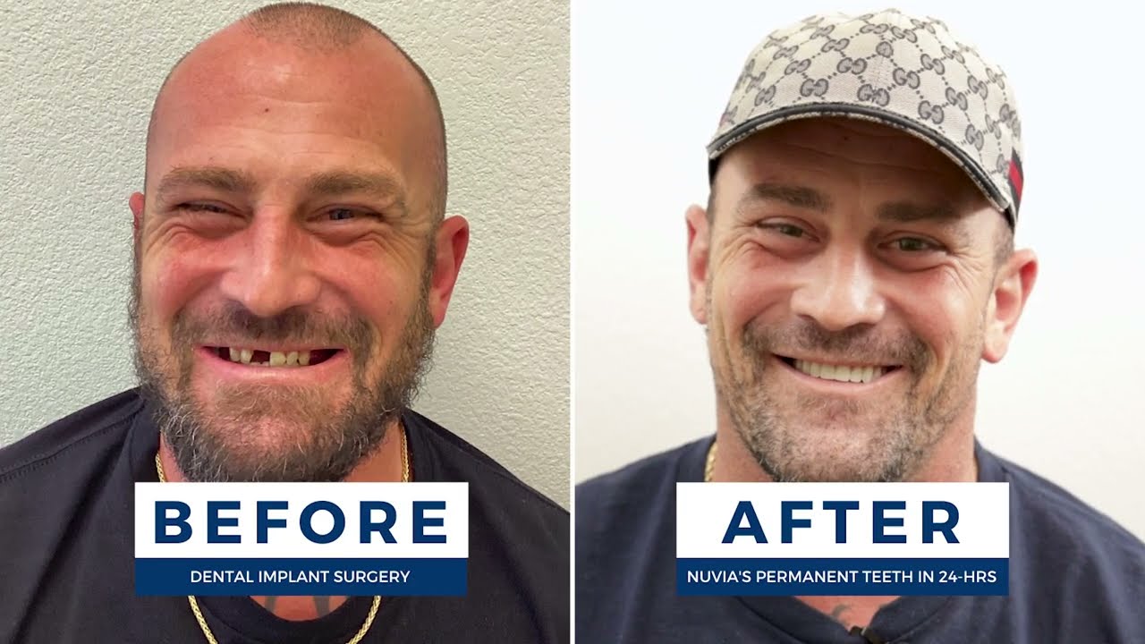 Don't Let Gaps In Your Smile Hold You Back Any Longer | Smile Makeover