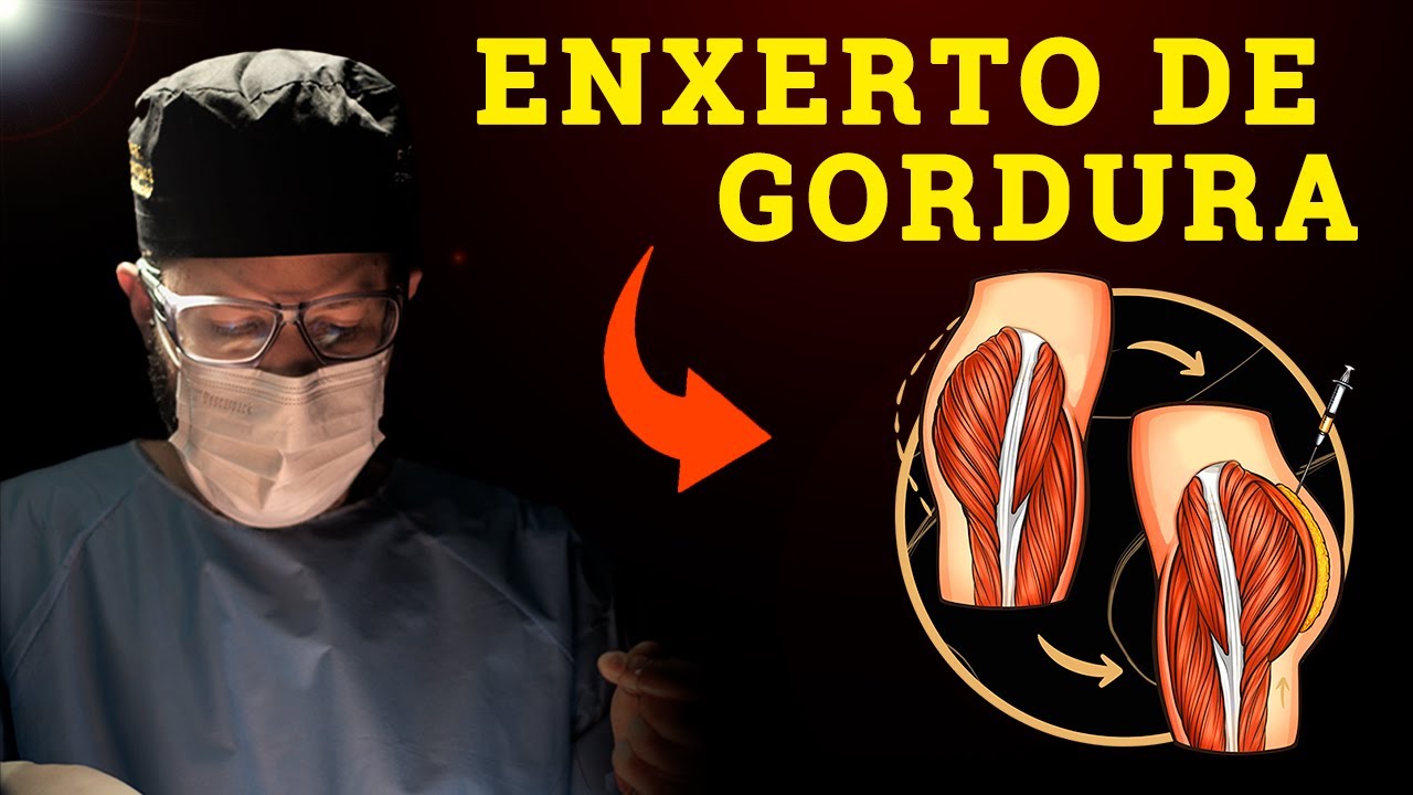 ENXERTO DE GORDURA - Migra? Absorve? Com Academia Pode Sumir?  🟢
