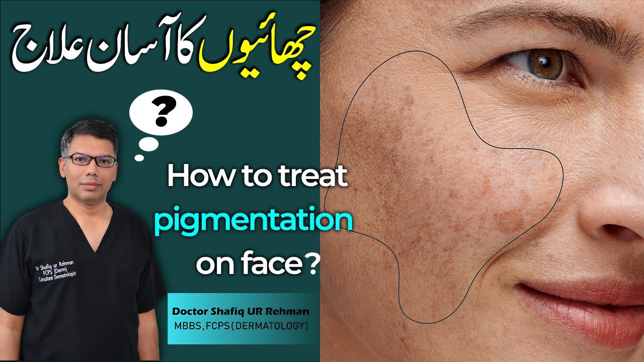 How to treat pigmentation on face ? || Doctor Shafiq Ur Rehman