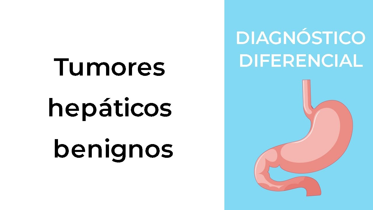 Diagnóstico Diferencial. Tumores hepáticos benignos
