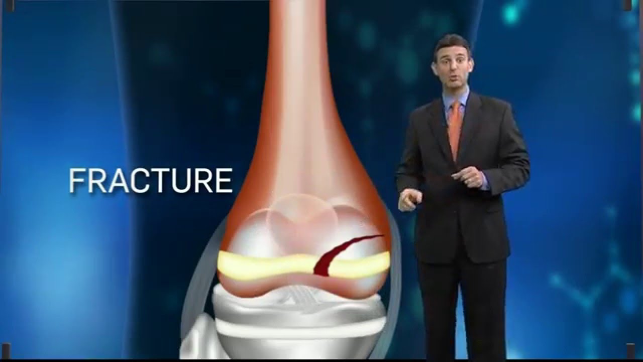 Fracture Dangers