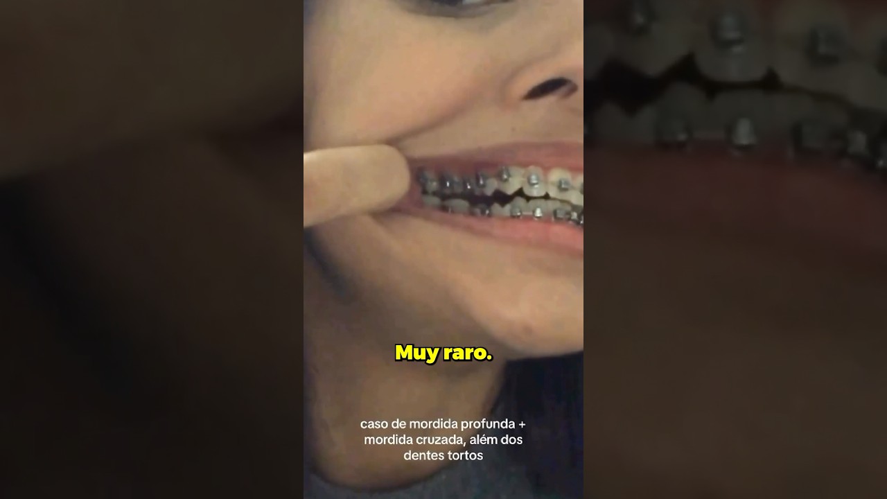 &iquest;Tienes mordida cruzada? Este es el antes y despu&eacute;s de corregirla